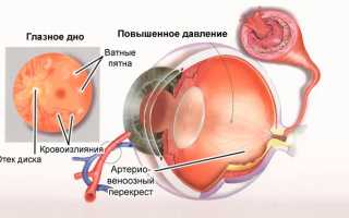 Повышенное глазное давление симптомы у взрослых