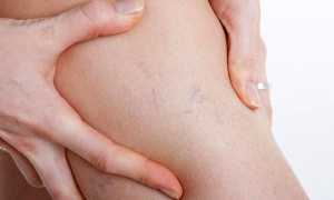 Народные средства лечения варикоза ног у женщин