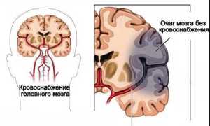 Питание при ишемическом инсульте головного мозга