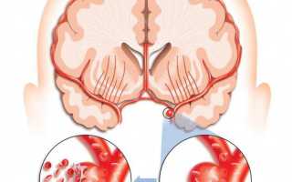 Лечение при сужении сосудов головного мозга