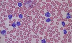 Повышенный уровень лимфоцитов в крови причины