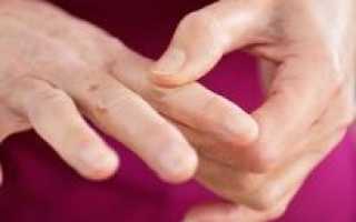 Медикаментозное лечение онемения пальцев рук